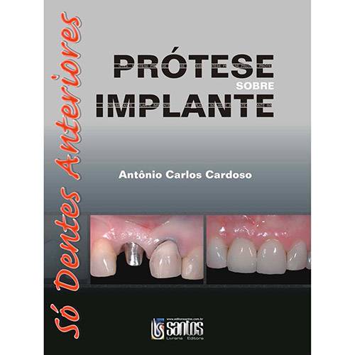 Tamanhos, Medidas e Dimensões do produto Livro - Prótese Sobre Implante: só Dentes Anteriores