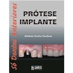 Livro - Prótese Sobre Implante: só Dentes Anteriores